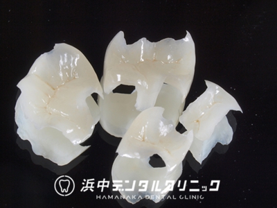 セラミックインレー(IPS e.max)